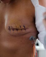 cancer survivor with open buttons showing stitches on breast